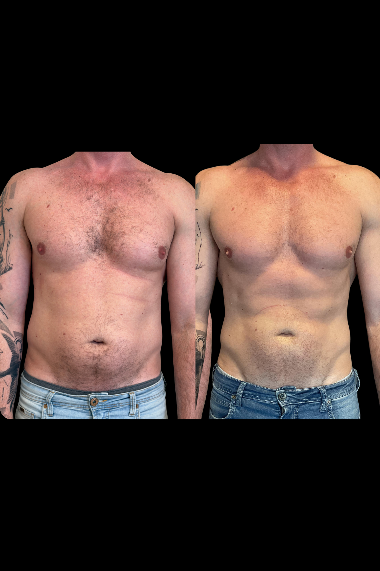 Antes e depois resultado HIPRO